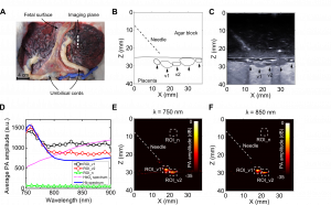 Multispectral photoacoustic images of the human placenta. (A)Photograph of the human twin placenta. Ultrasound and photoacoustic imaging were performed at the location indicated with a white dashed line in (A). An ultrasound image of the placenta together with the image outlines are shown in (C and B). Co-registered Photoacoustic images at wavelength of 750 nm and 850 nm are shown in (E) and (F). Photoacoustic images corresponded well to the ultrasound images. Two major blood vessels [v1 and v2 in (B) and (C)] were clearly visible in photoacoustic images. Average photoacoustic amplitudes for regions of interest (v1: ROI v1; v2: ROI v2; background noise: ROI n) indicated in (E)-(F) are compared with the absorption spectra of oxygenated and deoxygenated blood in (D) for wavelengths from 750 nm to 900 nm. The oxygenated and deoxygenated blood spectra are normalized to the measured average photoacoustic amplitudes at 750 nm for comparison. The photoacoustic signal amplitudes are averaged over 15 image frames, the error bars represent standard deviations.