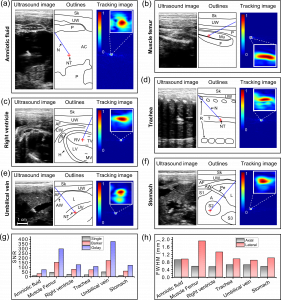 Ultrasound and tracking images obtained during insertions in the context of fetal inter- ventions in a sheep in vivo, including: (a) amniotic  fluid; (b) muscle femur; (c) right ventricle; (d) trachea; (e) umblical vein; and (f) stomach; For each insertion, the ultrasound image and the corresponding outlines is on the left, with the tracking image on the right. The signal-to-noise ratios (SNRs) and the full width at half maximum (FWHM) values of the lateral and axial proles for tracking images with different excitation methods (single cycle bipolar wave, Barker coding and Golay coding) are compared in (g) and (h) respectively. The dimensions of inserts in all tracking images are 2 mm  2 mm. Needle tip positions are marked as red crosses according to the positions of maximums in the tracking images. N: Needle; NT: Needle tip; Sk: Skin; UW: Uterine wall; P: Placentome; AC: Amniotic cavity; Mu: Muscle; F: Femur; AF: Amniotic  uid; CW: Chest wall; RV: Right ventricle; LV: Left ventricle; R: Ribs; H: Heart; TV: Tricuspid valve; MV: Mitral valve; T: Trachea; AW: Abdominal wall; L: Liver; UV: Umbilical vein; M: Membrane; A: Abdomen; S: Stomach; Pe: Peritoneum.