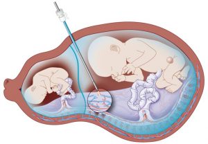 Example Caption: Figure 1 Illustrating the  proposed therapy for Twin-to-Twin Transfusion Syndrome